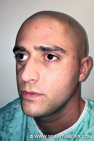 The patient was left with no scars at all after an eight-hour facial reconstruction surgery