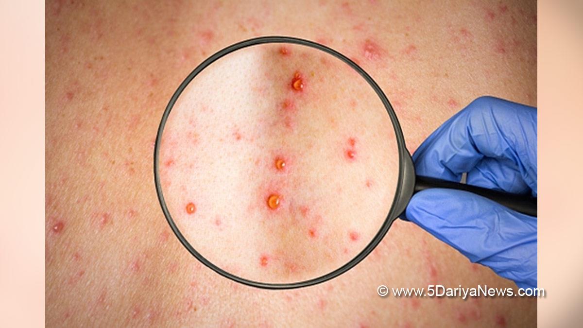 Health, UK Health Security Agency, UKHSA, Monkeypox