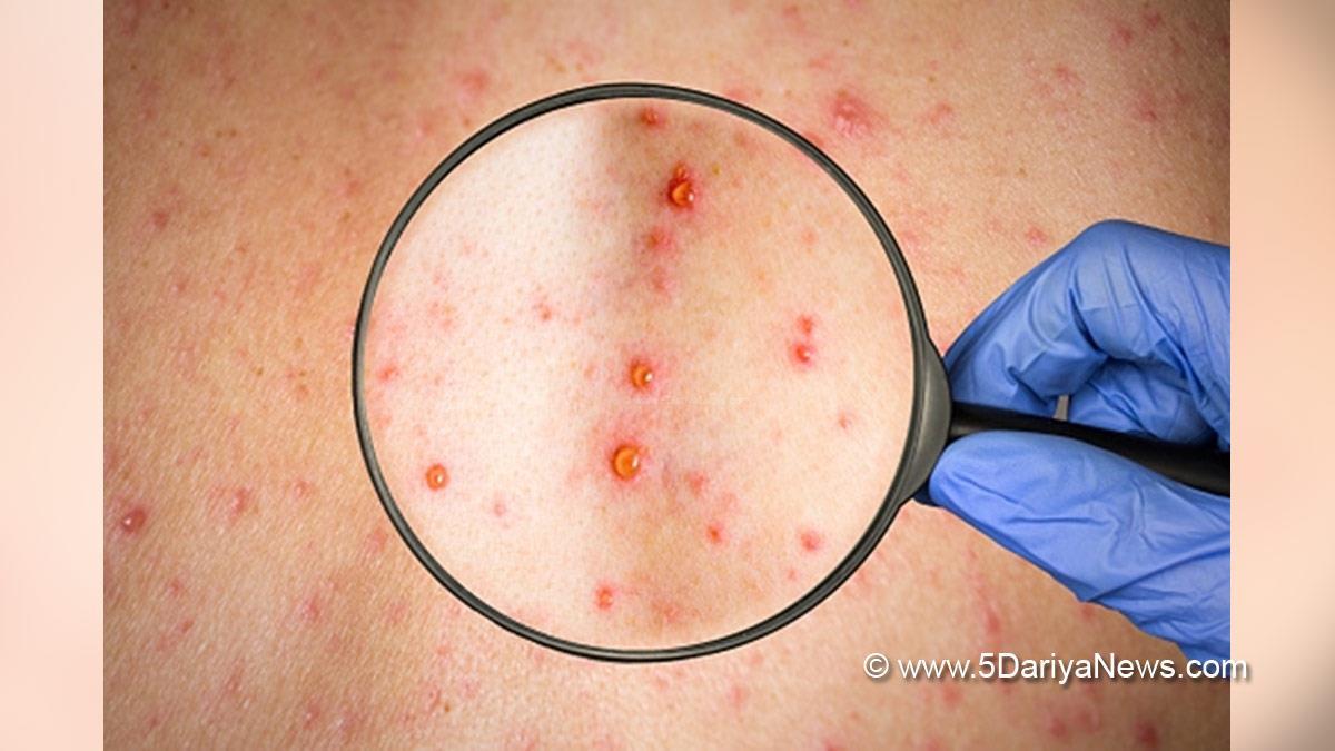 Monkeypox Virus , Monkeypox , Health , Study , Research , Researches , Symptoms Monkeypox Virus , MonkeyPox Disease , Monkeypox Symptoms , MonkeyPox Cures