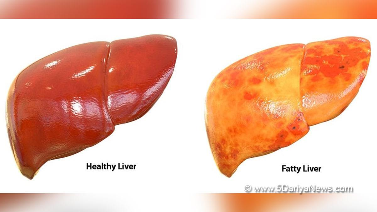 Fatty Liver, Liver, Health, Study, Research, Fatty Liver Symptoms, Fatty Liver Treatment, Fatty Liver Diet, Fatty Liver Precautions