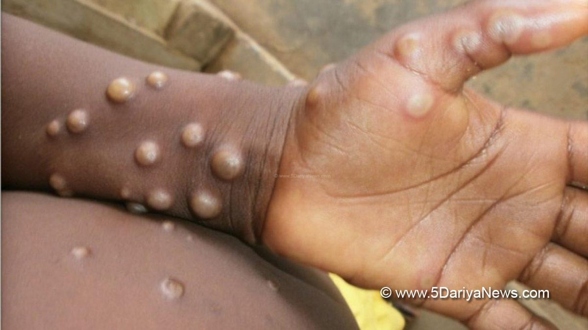 Monkeypox Virus , Monkeypox , Health , Study , Research , Researches , Symptoms Monkeypox Virus , MonkeyPox Disease , Monkeypox Symptoms , MonkeyPox Cures, Monkeypox Vaccine