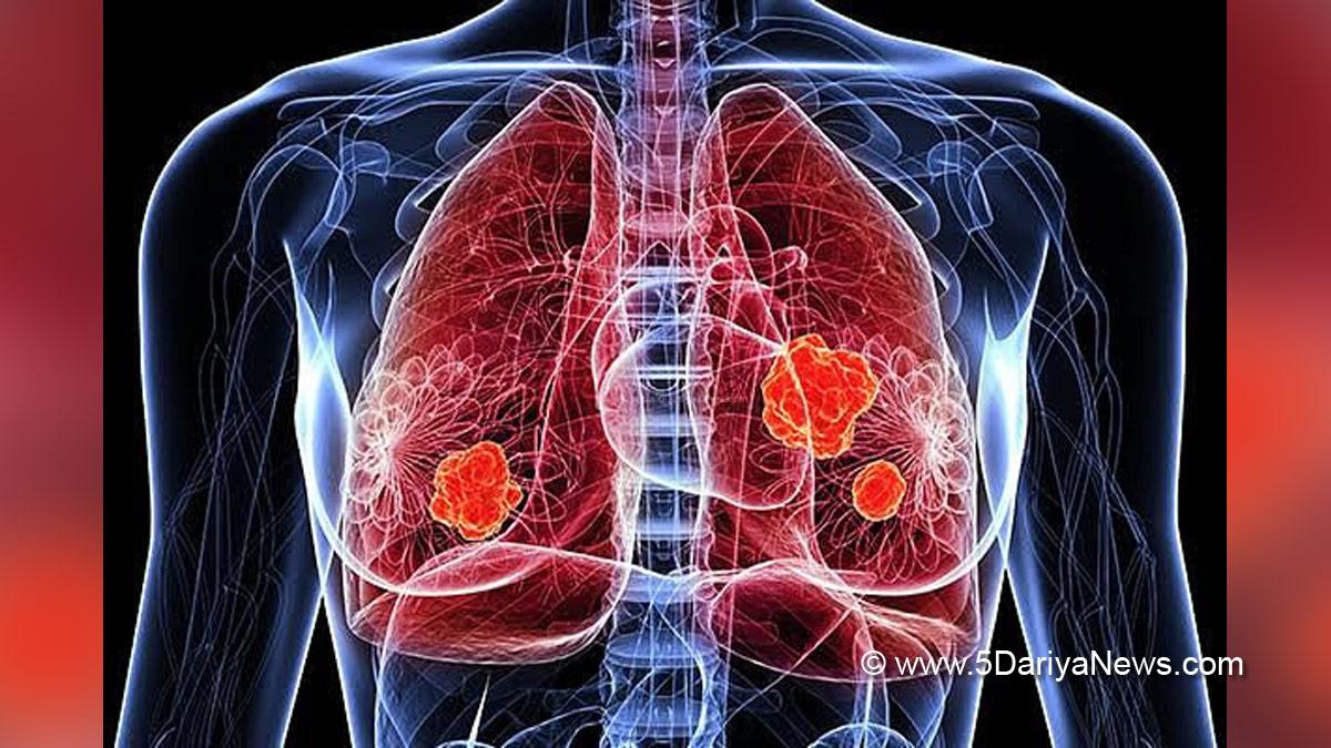 Health, Study, Research, Cancer, Lung Cancer, Lung Cancer Symptoms, Lung Cancer Treatment, Lung Cancer Causes, Lung Cancer Types, Lung Cancer Diagnosis