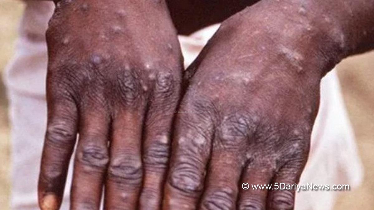 Monkeypox Virus , Monkeypox , Health , Study , Research , Researches , Symptoms Monkeypox Virus , MonkeyPox Disease , Monkeypox Symptoms , MonkeyPox Cures, Israel, Jerusalem