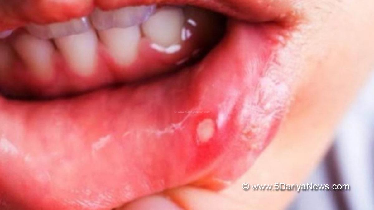 Health, Study, Research, Ulcer, Ulcers, Ulcers Meaning, Ulcers Meaning In Hindi, Ulcers In Mouth, Ulcers In Mouth Reasons, Ulcers In Mouth Remedies, Ulcers In Mouth In Hindi, Ulcers In Mouth Gel, Ulcers In Mouth Cancer