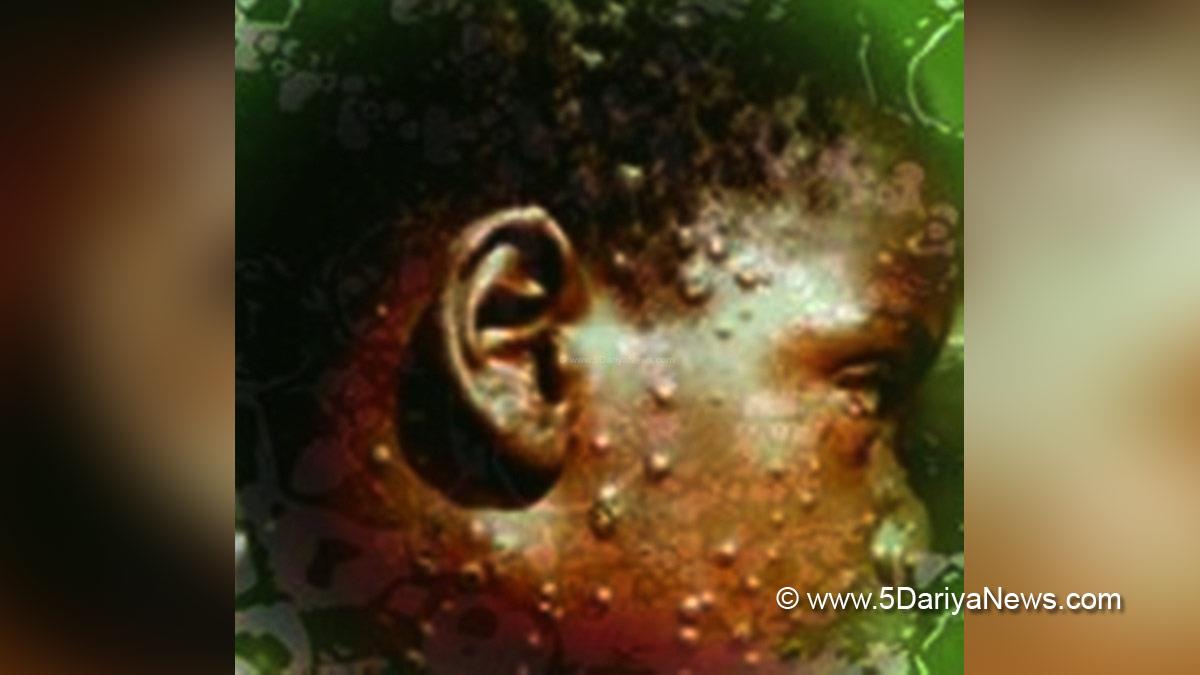 Health, Monkeypox Virus, Monkeypox, Health, Study, Research, Researches, Symptoms Monkeypox Virus, MonkeyPox Disease, Monkeypox Symptoms, MonkeyPox Cures, Israel, Jerusalem