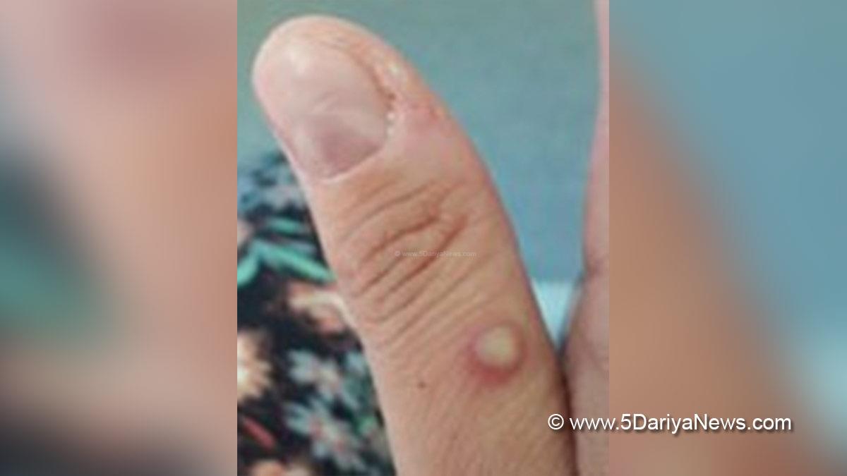 Health, Monkeypox Virus, Monkeypox, Health, Study, Research, Researches, Symptoms Monkeypox Virus, MonkeyPox Disease, Monkeypox Symptoms, MonkeyPox Cures