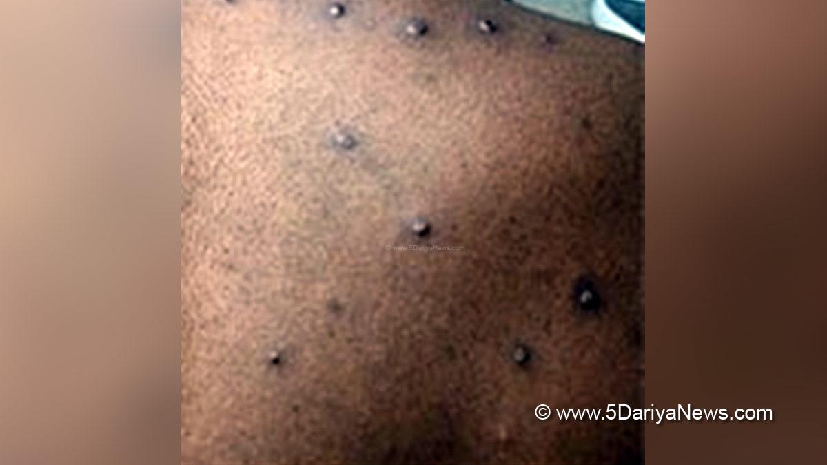 Monkeypox, Health, Monkeypox Virus, Symptoms Monkeypox Virus, MonkeyPox Disease, Monkeypox Symptoms, MonkeyPox Cures,Monkeypox scare