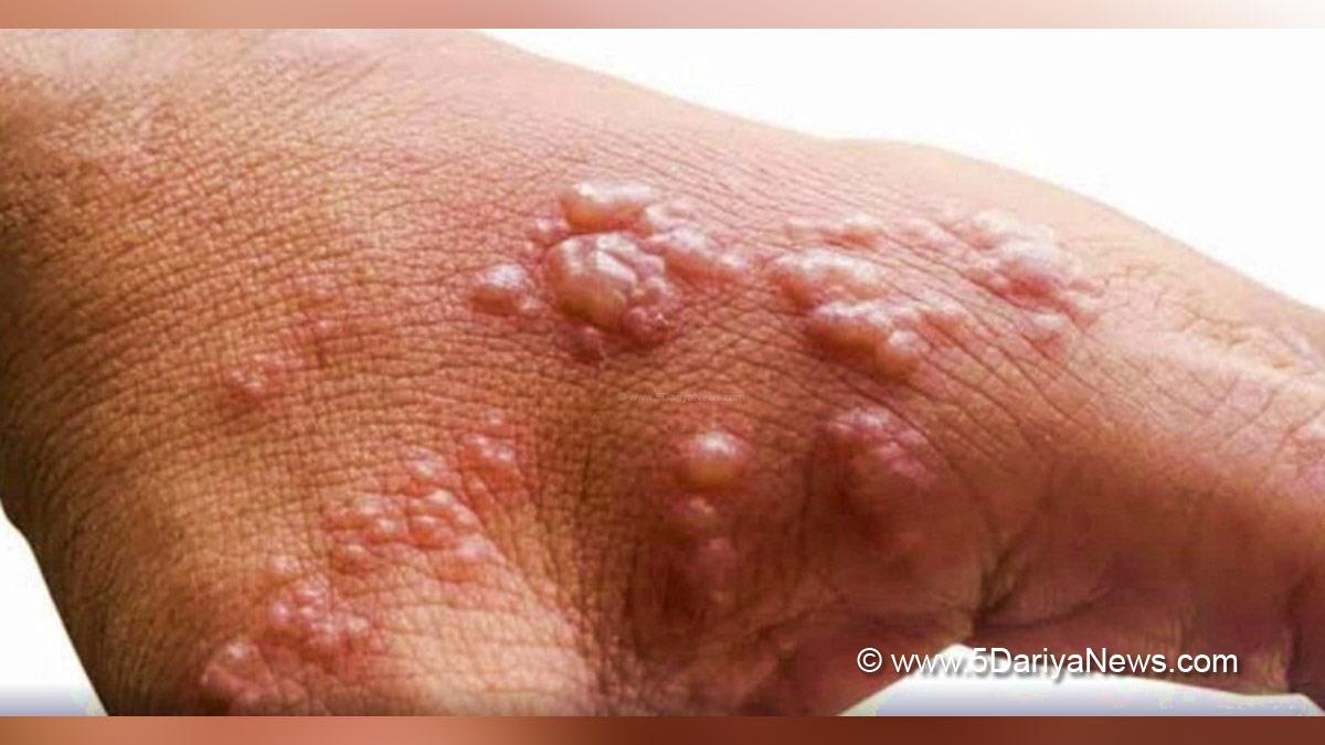 Monkeypox, Health, Monkeypox Virus, Symptoms Monkeypox Virus, MonkeyPox Disease, Monkeypox Symptoms, MonkeyPox Cures, Monkeypox Scare
