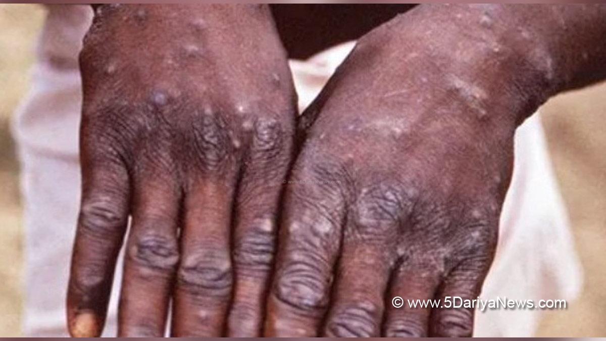 Health, Monkeypox Virus, Monkeypox, Health, Study, Research, Researches, Symptoms Monkeypox Virus, MonkeyPox Disease, Monkeypox Symptoms, MonkeyPox Cures