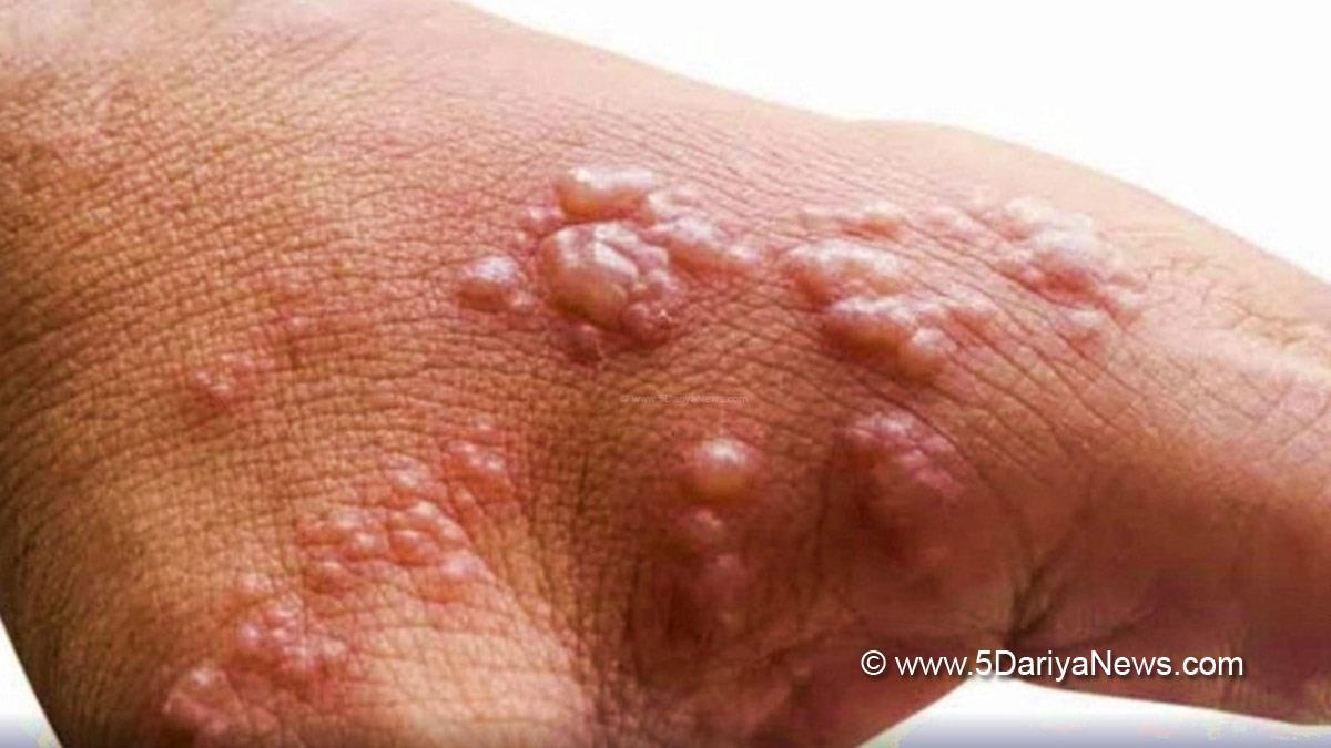Health, Study, New York, Research, Researchers, World News, Monkeypox, Mpox, Monkeypox News, Monkeypox India, Monkeypox Cases, Monkeypox Cases India