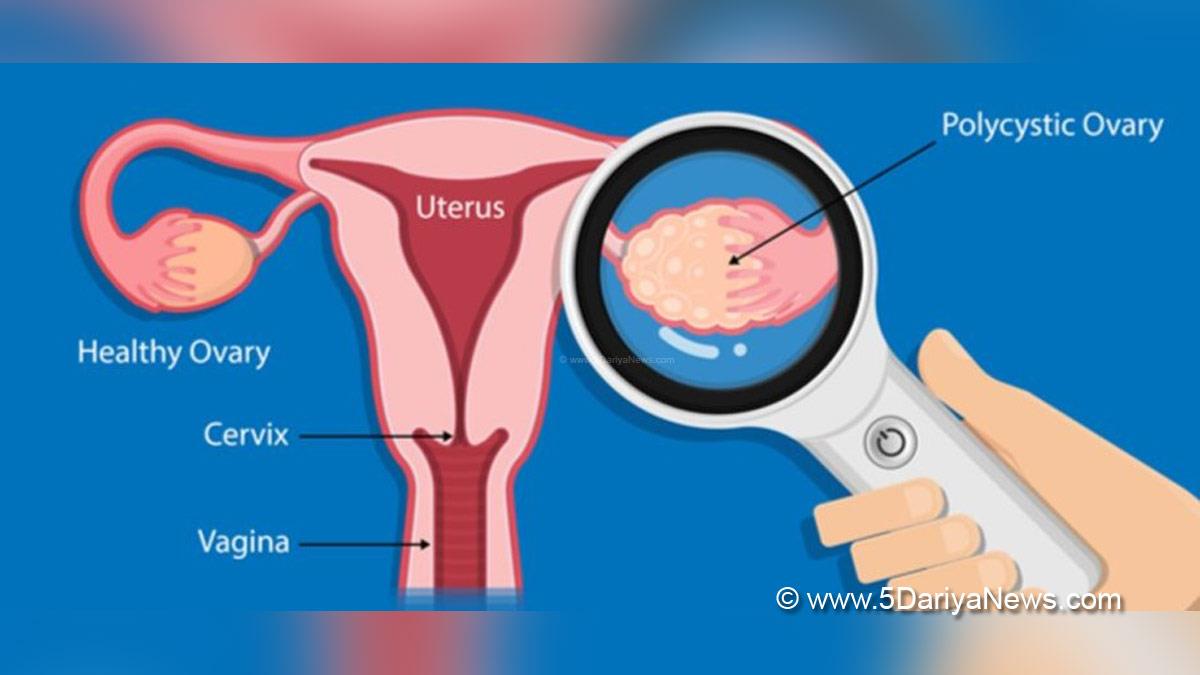 Health, Study, New York, Research, Researchers, World News, Polycystic Ovary Syndrome, PCOS, European Society of Human Reproduction and Embryology, ESHRE, Dr Clarissa Frandsen, Danish Cancer Society, Ovarian Cancer, Breast Cancer