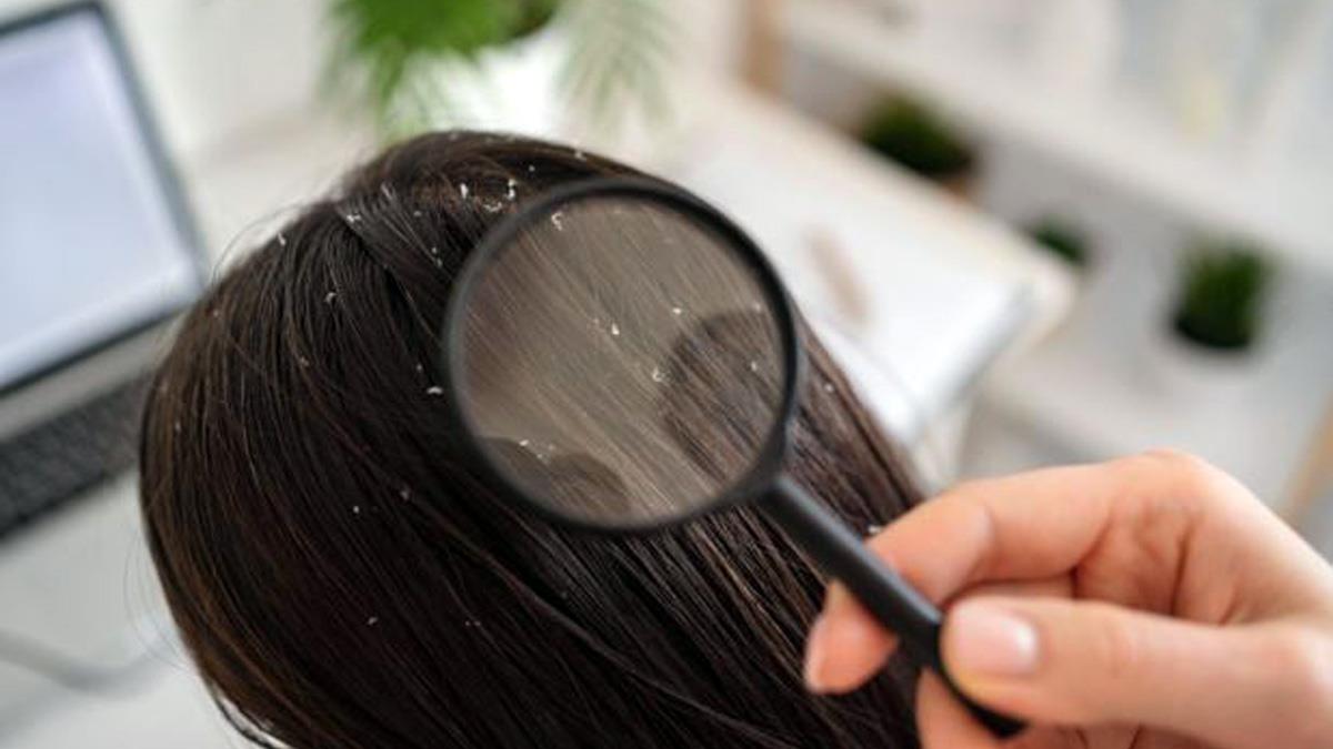 Dry Scalp vs Dandruff